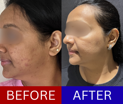 Cystic acne before and after — 3-year recurring case treated with a structured dermatology protocol