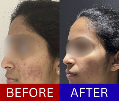 Acne scar correction before and after — 5-year case treated through a staged scar protocol over 6 months