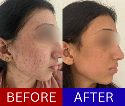 Hormonal adult acne before and after — diagnosed and treated through hormonal-cycle adjusted protocol over 4 months
